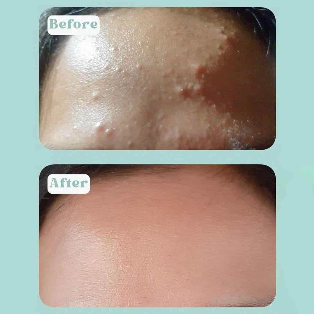 Seoul White KoreaBye Bye Acne Serum Toner 150ml