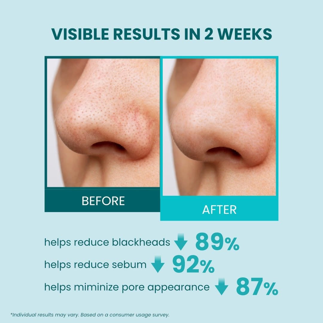 Luxe Organix 24/7 Supercharged Acne & Sebum Melting 2in1 Clarifying Serum Concentrated Pads
(Pore Shrinking + Blackhead Melting)