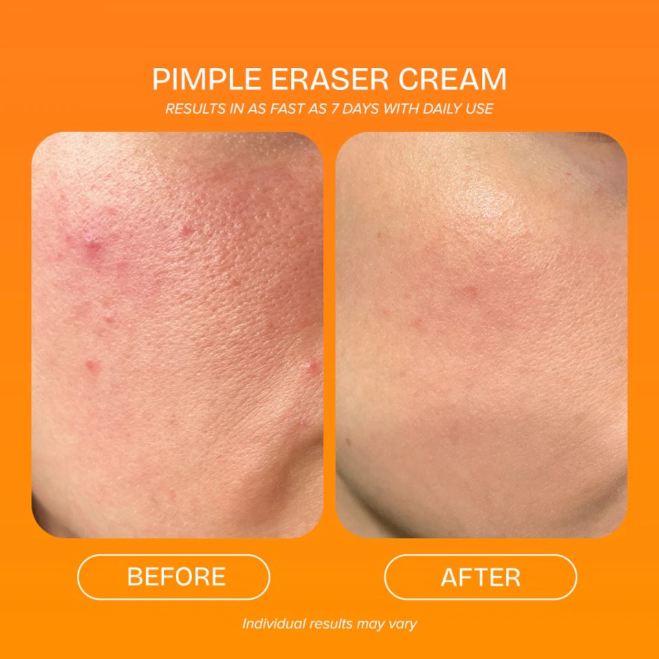 QUICKFX Pimple Eraser 30g